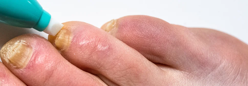 Nagelpilzbehandlung