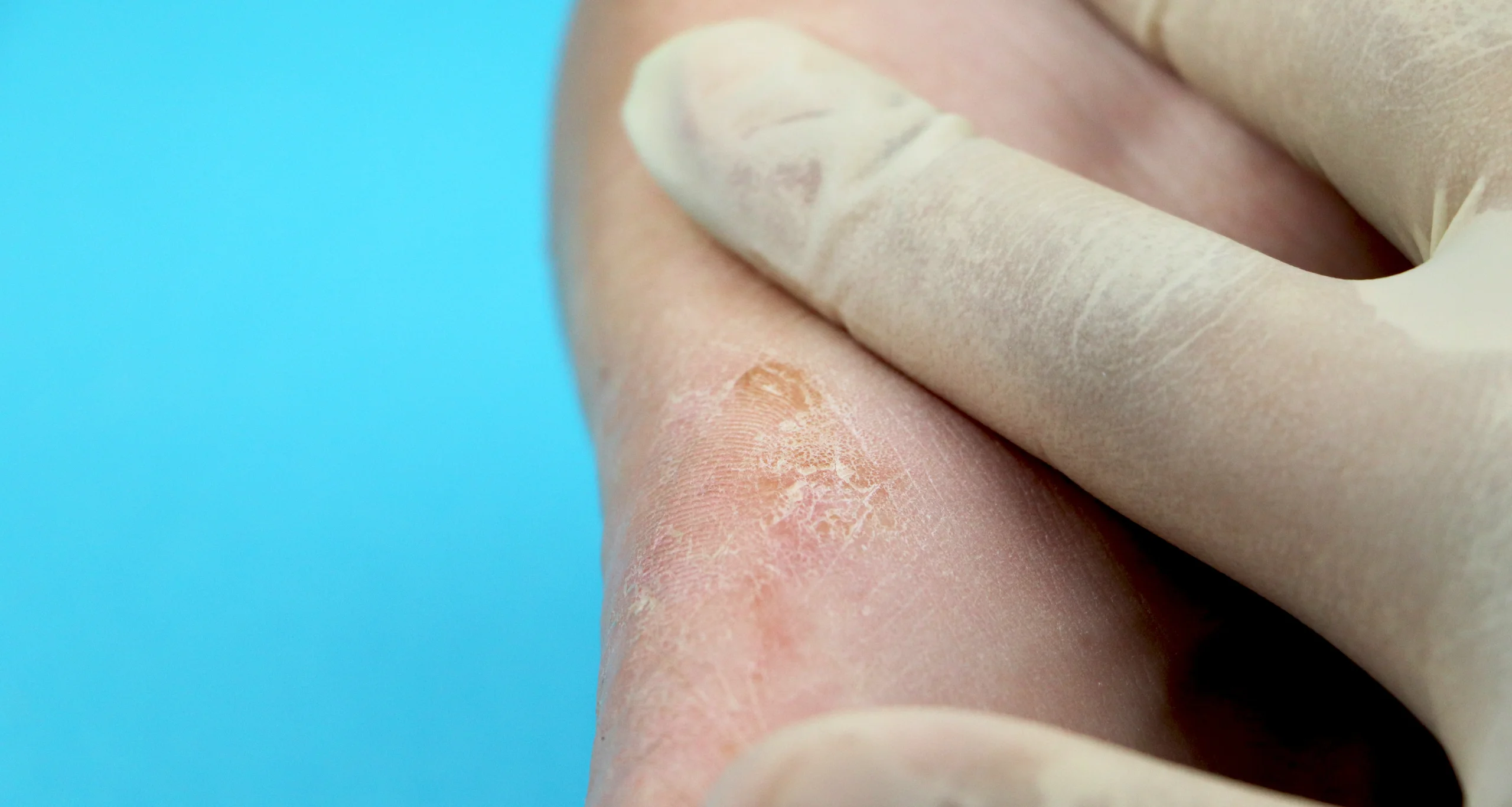 Nagelpilzbehandlung
