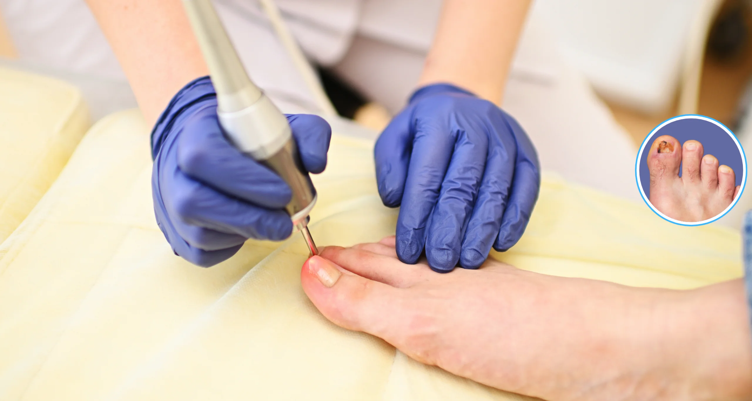 Nagelpilzbehandlung